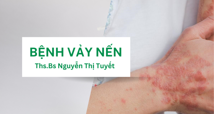 Chuẩn đoán và cách điều trị bệnh vảy nến thông thường
