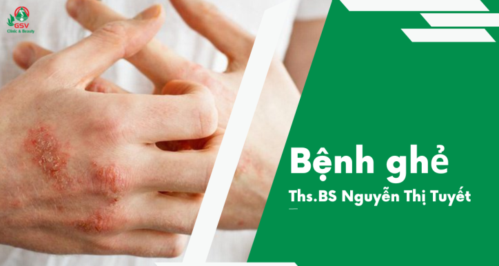 Chẩn đoán và cách điều trị bệnh ghẻ