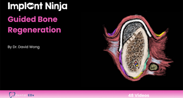 Ninja Guided Bone Regeneration